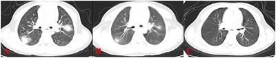 Clinical Features of Hypersensitivity Pneumonitis in Children: A Single Center Study